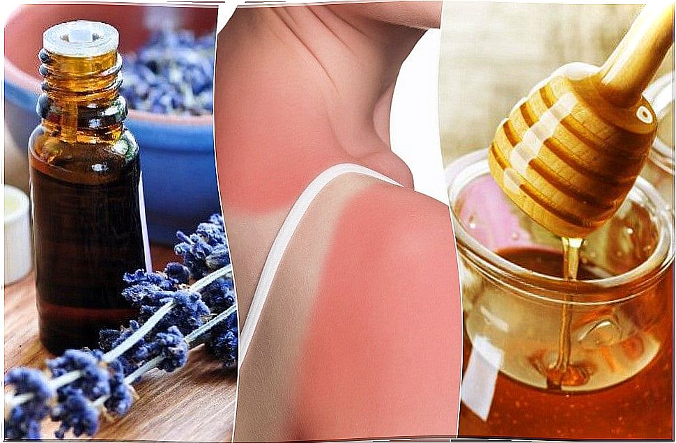 7 natural remedies to treat first degree burns