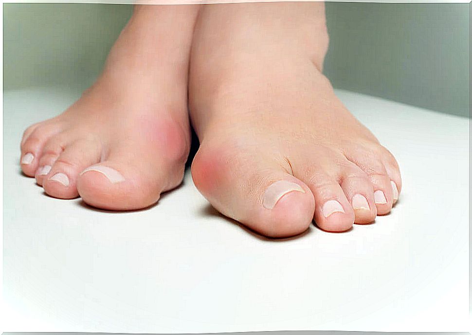 7 ways to ease bunion pain