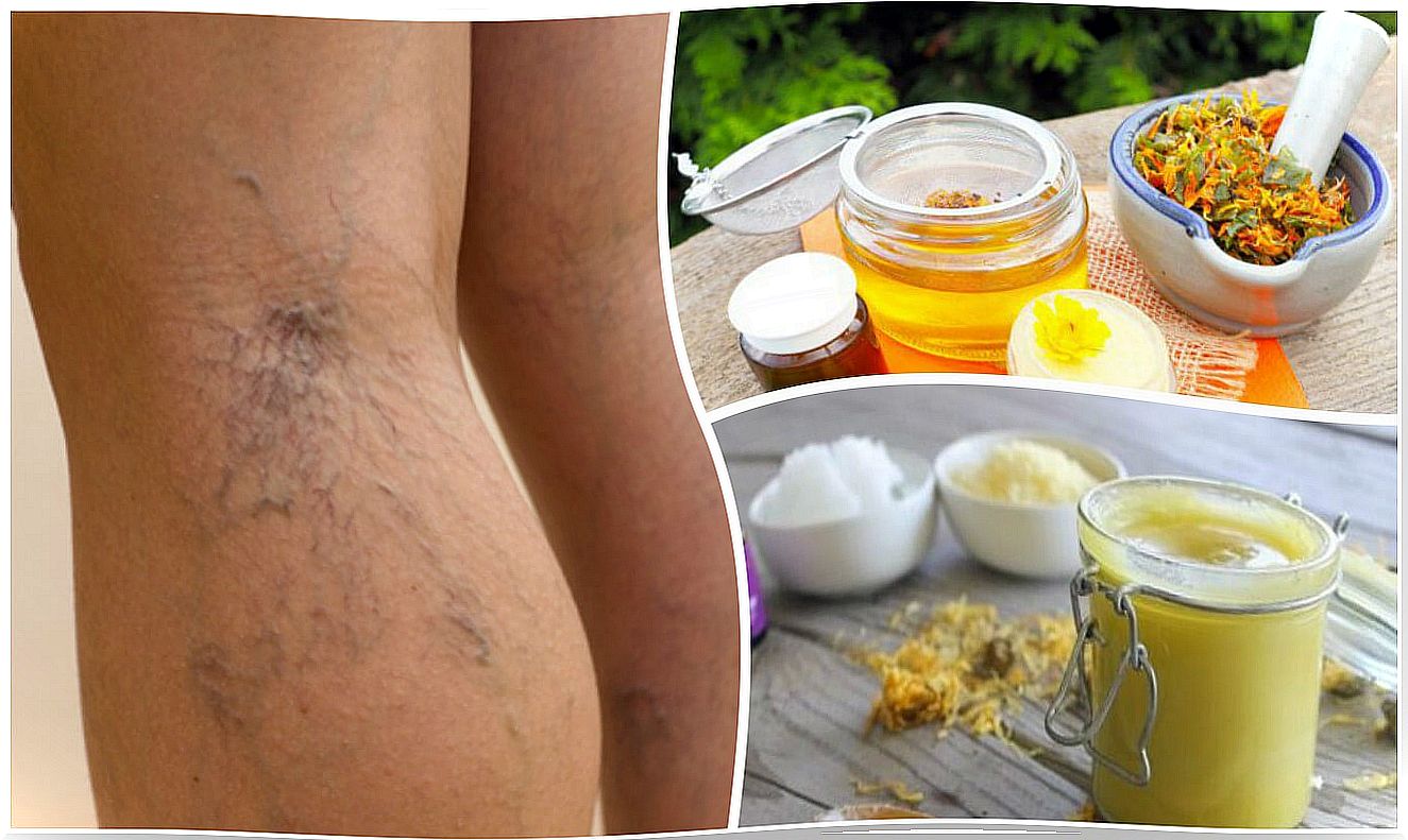 Arnica ointment to reduce varicose veins and spider veins