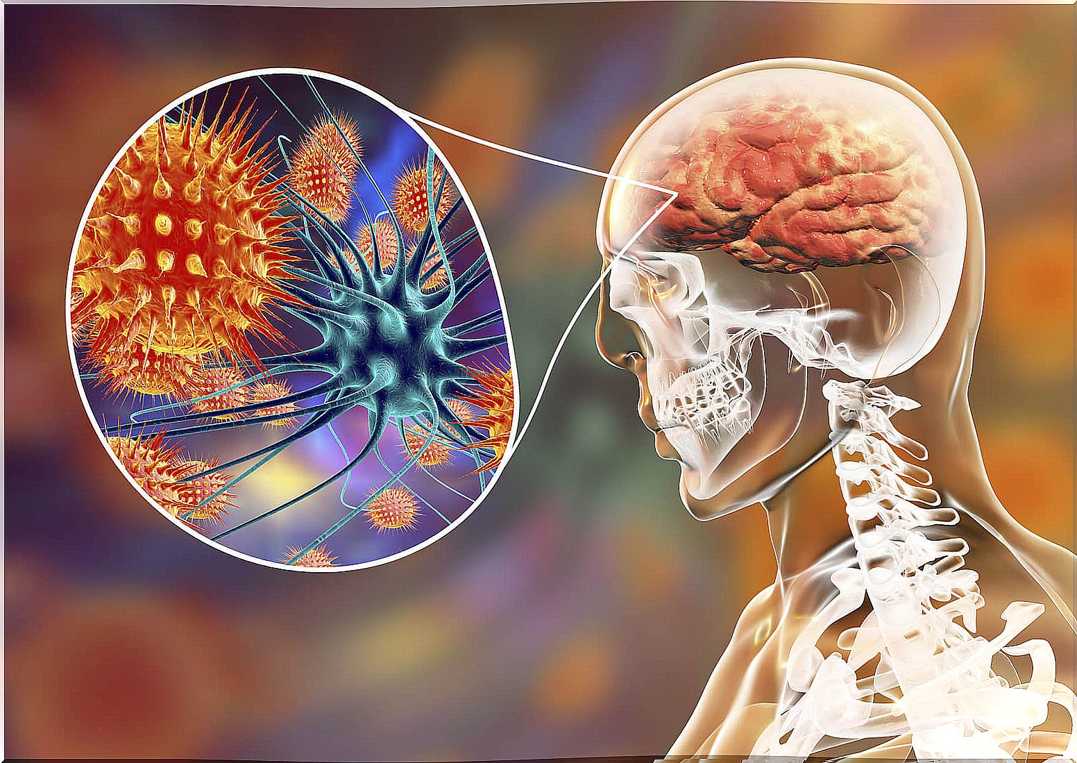 Viral encephalitis.