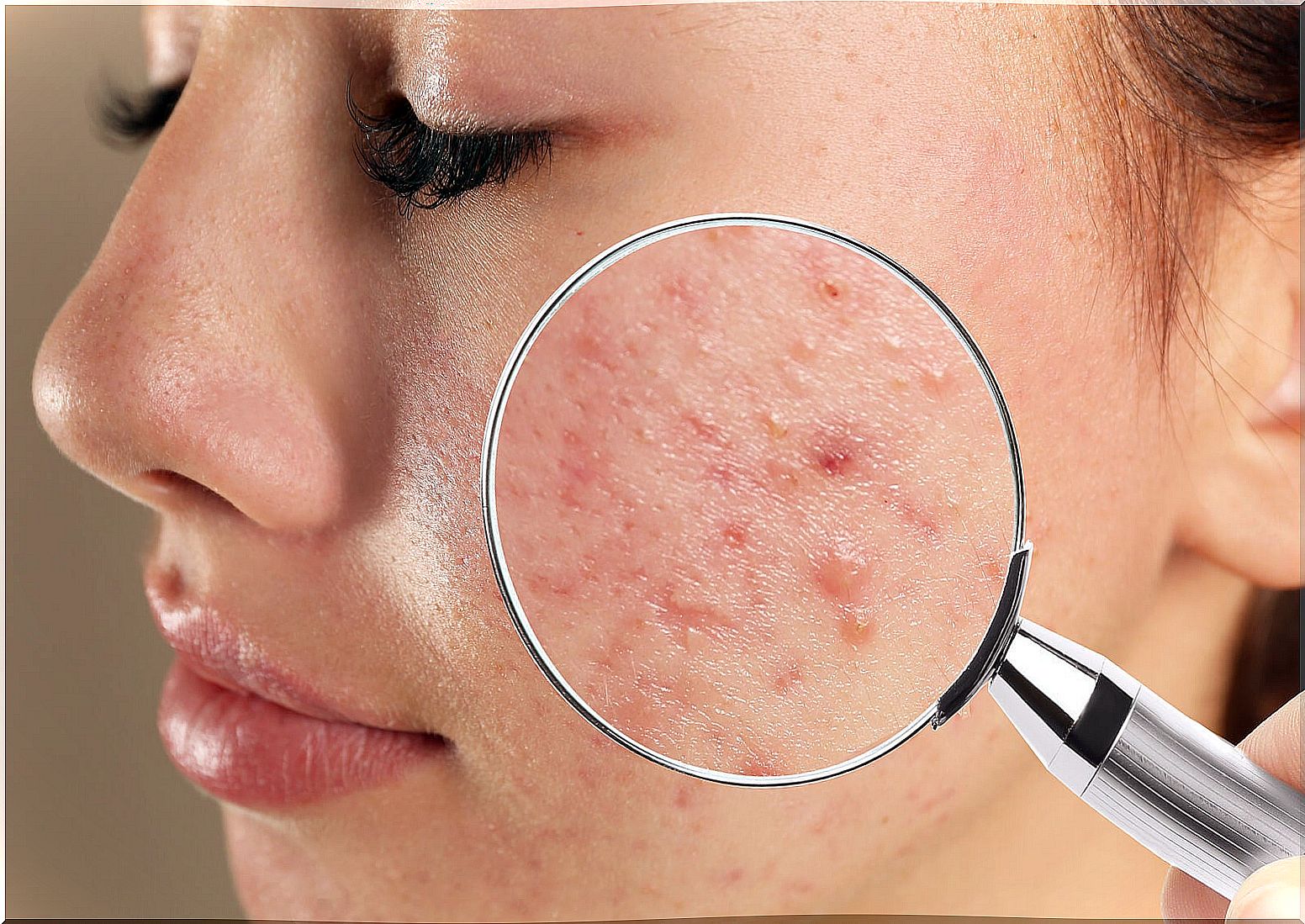 Do you know what acne can reveal about your health?