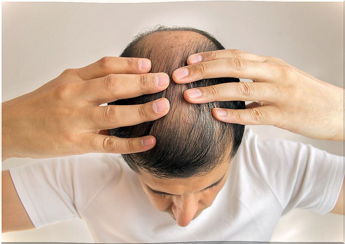 Male alopecia