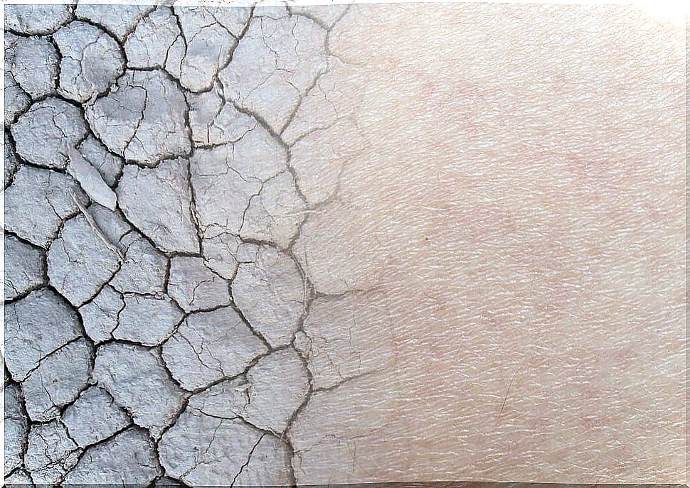 Some medications like Diprogenta can cause dry skin.