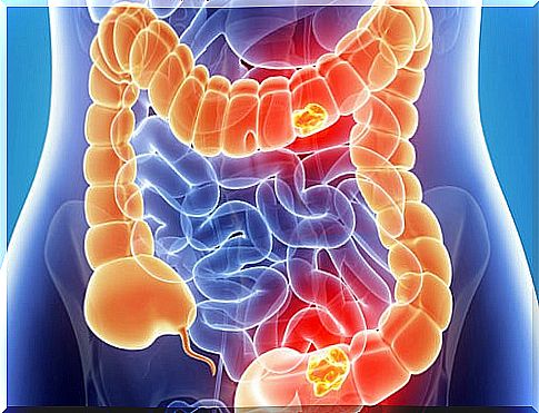 bowel problems: colon cancer