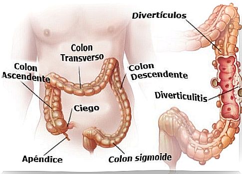 intestinal problems: diverticula