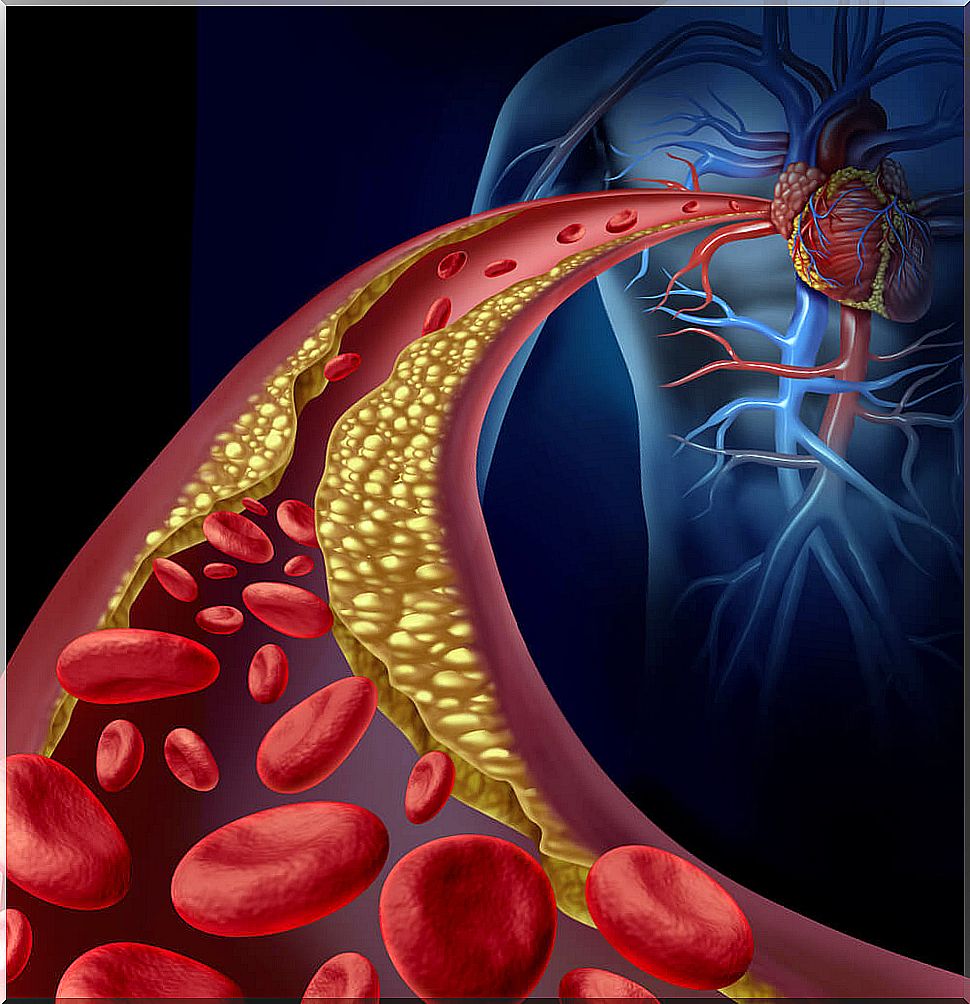 Atherosclerosis and risk of heart attack.