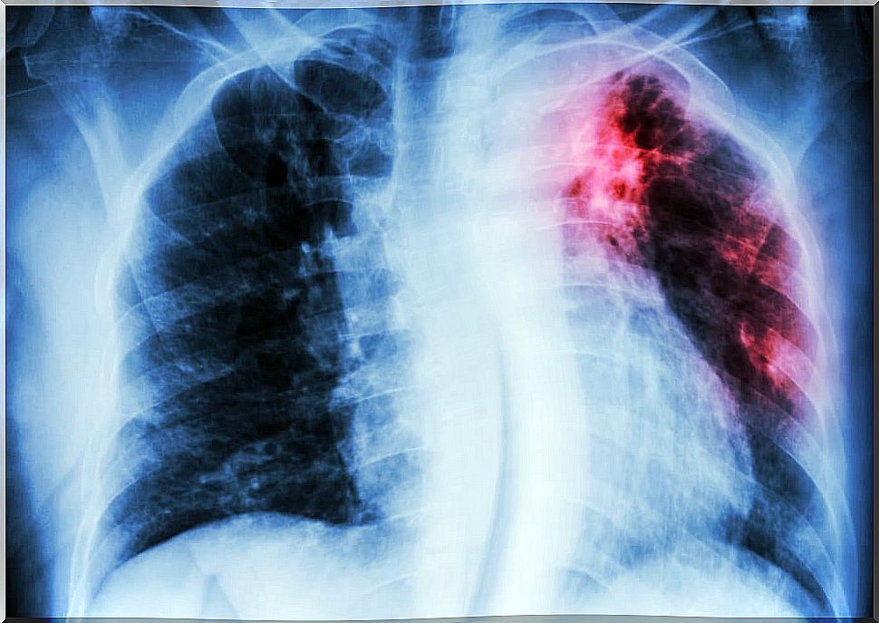 X-ray of a person with interstitial lung disease