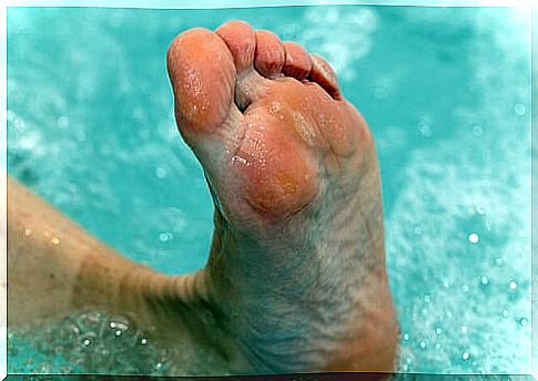 Pickled feet: athlete's foot treatment