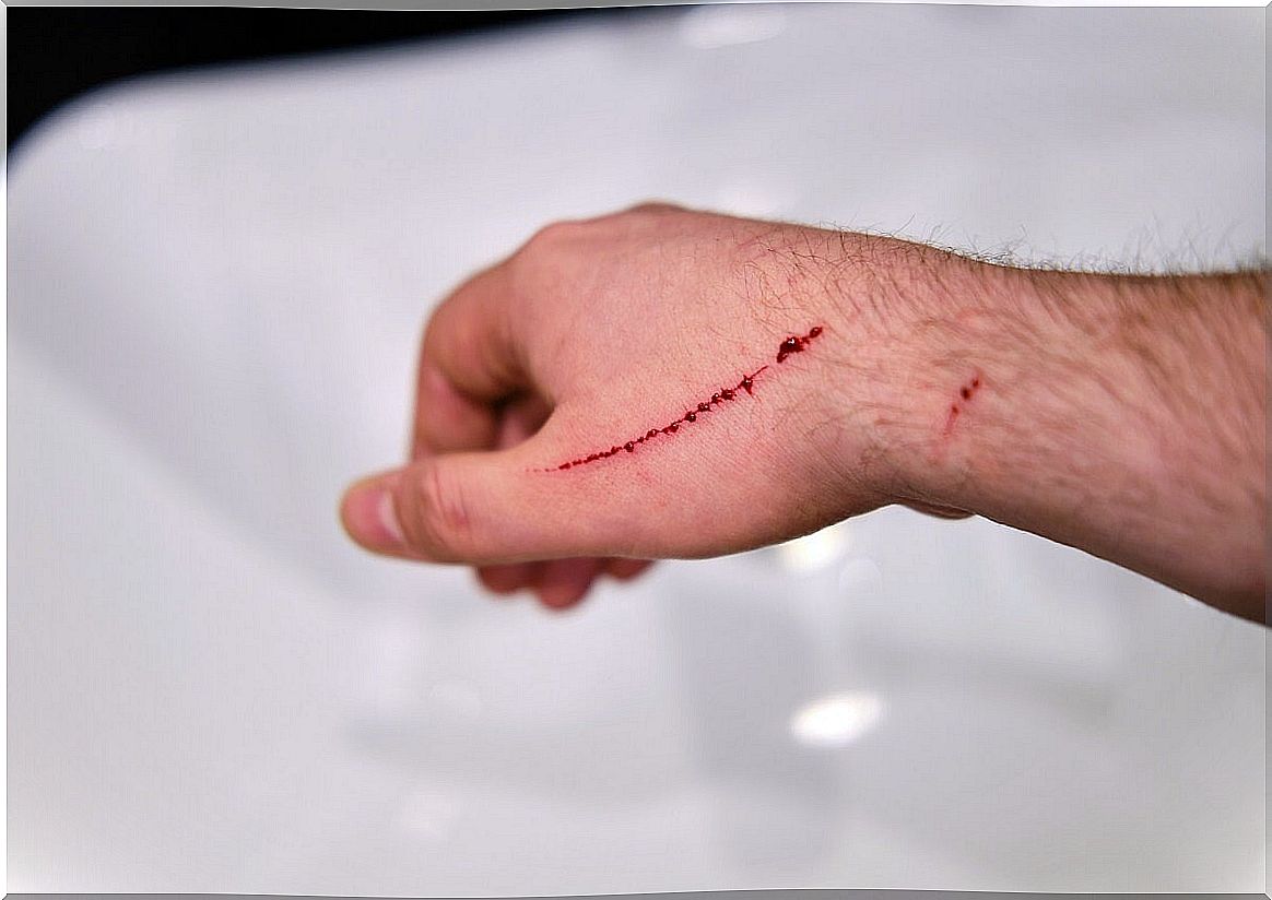 Wound requiring surgical suture.