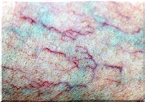 What do I do if I start to get varicose veins?