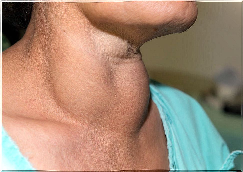 Lipoma on the neck.