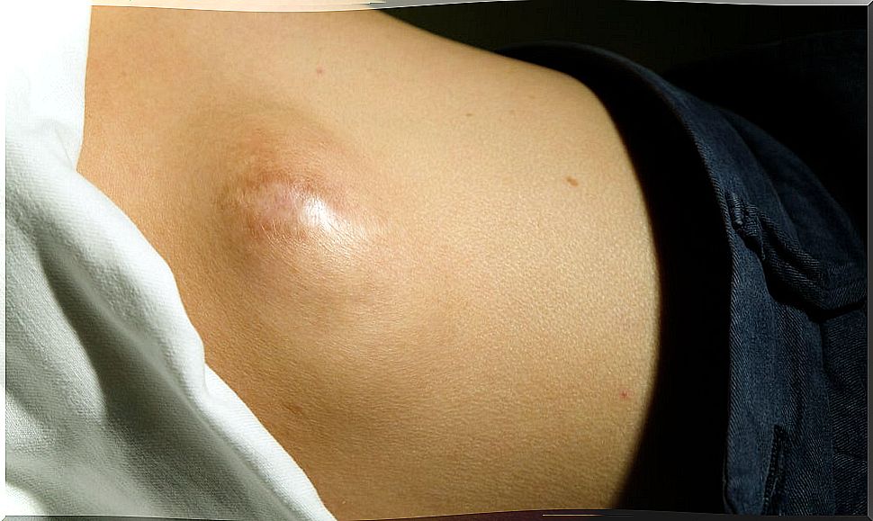 Causes of lipoma of the abdomen